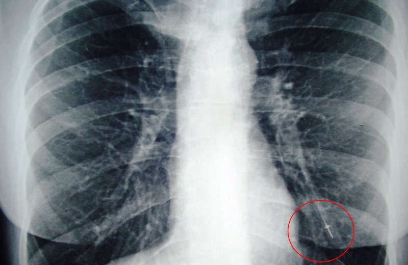 Αυξάνονται οι ασθενείς με καρκίνο του πνεύμονα το 2015