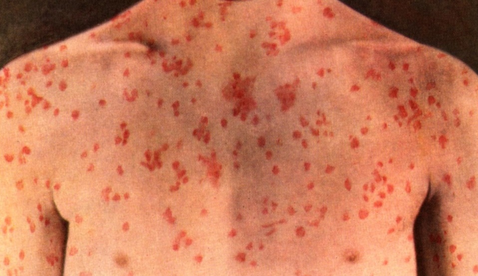 Επικίνδυνη η αναζωπύρωση της ιλαράς- Τι λένε οι γιατροι 