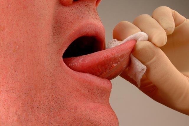 Καρκίνος του στόματος: Παράγοντες κινδύνου και πρόληψη