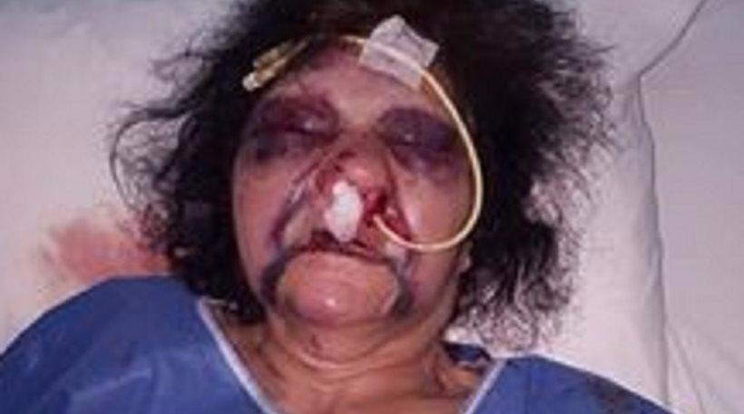 Σοκαριστική φωτογραφία: Ηλικιωμένη έπεσε θύμα άγριου ξυλοδαρμού στη Ρόδο