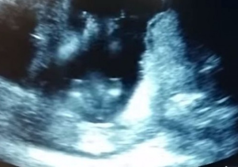 Απίστευτο βίντεο: Έμβρυο “χτυπάει παλαμάκια” ακούγοντας μουσική 